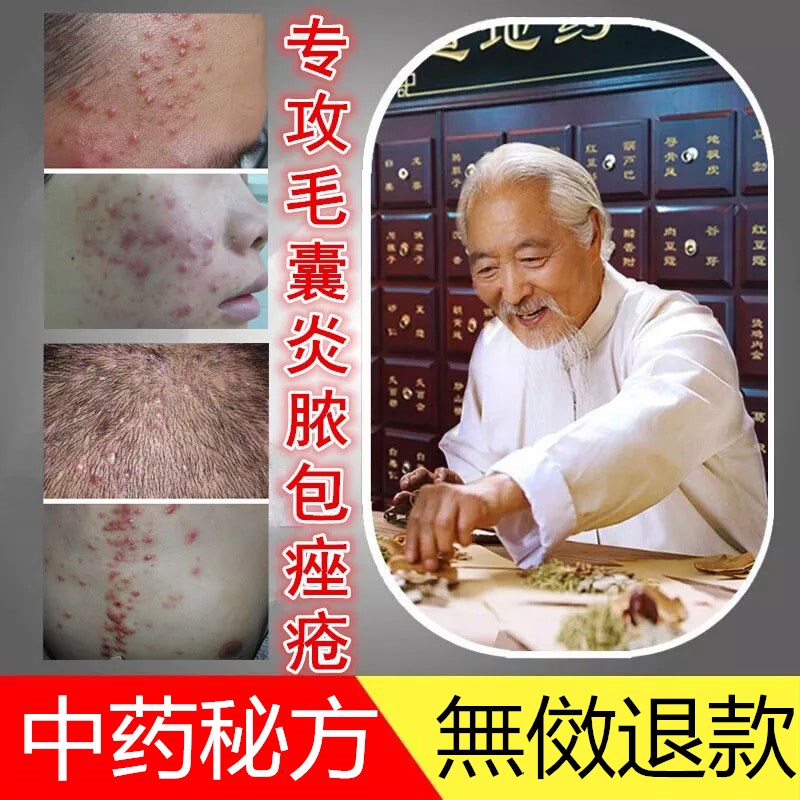 痘痘修复消炎内分泌调理祛痘药膏外用液下巴脓包型屁股痘痘排毒男