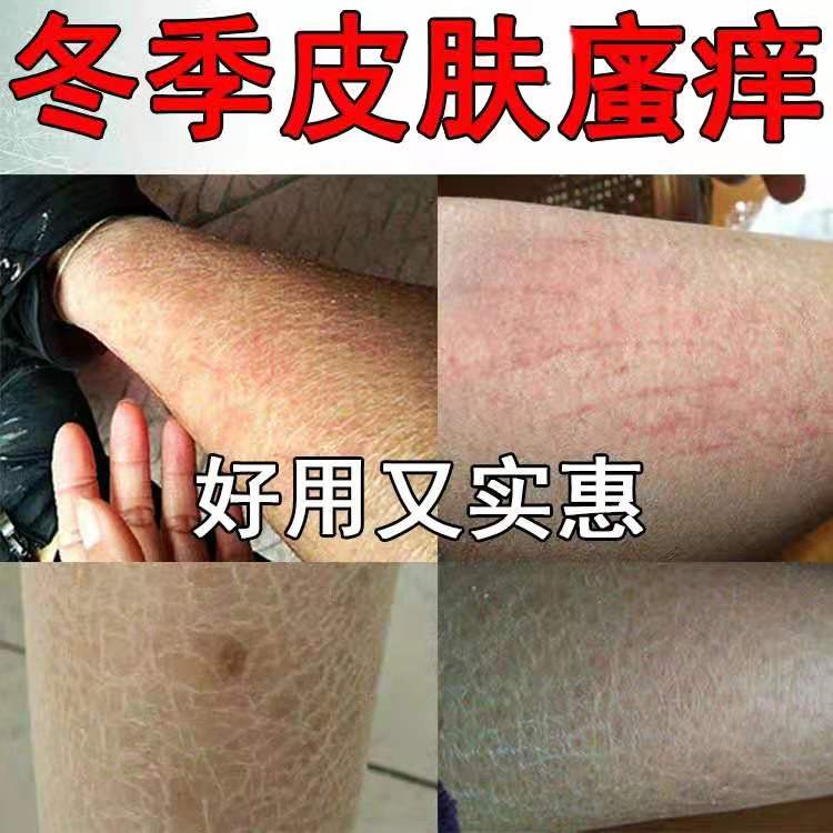 乐夫芙甲大白瓶官网止痒乐肤甲大白瓶冬天皮肤干燥瘙痒止痒膏起皮